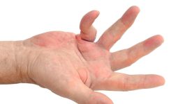 Breakthrough In Treatment For Dupuytren's Disease As Clinical Trial Shows Efficacy Of anti-TNF Drug