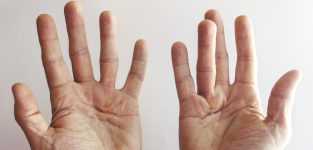 Breakthrough in treatment for Dupuytren’s disease
