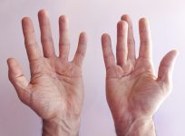 Decoding Dupuytren's: A Climber's Hand Disorder