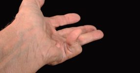Dupuytren's Contracture: 10 Things Doctors Want You to Know - Healthgrades
