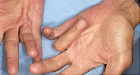Dupuytren's Contracture: Pictures, Symptoms, Causes, Treatments