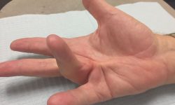 Dupuytren's Disease or Its Mimicker? Study Sheds Light on The Importance of Careful Diagnosis