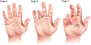 Dupuytren's: a systems biology disease | Arthritis Research & Therapy