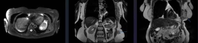 Extensive free silicone dissemination following chest trauma: a case report