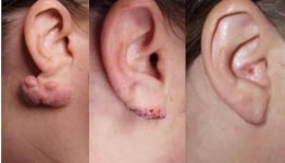 How I do keloid excision