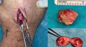 Mycetoma of the hand: an unusual case of _Actinomadura_ infection in Australia