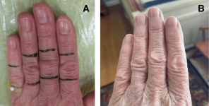 Radiotherapy for Symptomatic Knuckle Pads Associated With Dupuytren’s Disease: A Report of a Case Series - Cureus