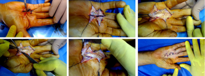 The importance of multiple Z- plasty- assisted physical therapy in the treatment of Dupuytren’s contracture | Journal of Orthopaedic Surgery and Research