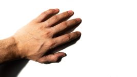 Treating Dupuytren's contracture without surgery