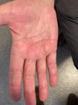 Treatment of Painless Nodules With Glucopuncture in Dupuytren's Disease in Men: A Clinical Case