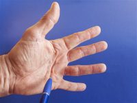What the commercials don't tell you about Dupuytren's contracture