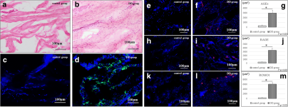 Association of advanced glycation end products in Dupuytren disease | Journal of Orthopaedic Surgery and Research