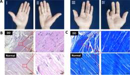 Effect of nanoparticle-mediated delivery of SFRP4 siRNA for treating Dupuytren disease