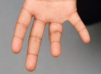 Paediatric Dupuytren’s Disease in a Child of Indian Ethnicity: A Case Report and Literature Review