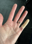 Raynaud’s Phenomenon After Fasciectomy for Dupuytren’s Contracture: A Case Report - Cureus