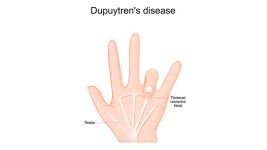 Study into common health condition compares surgery to less invasive treatment | News