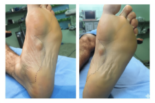 Ledderhose Disease and Dupuytren’s