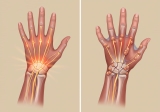 Carpal Tunnel Syndrome and Dupuytren’s: Overlapping Hand Conditions Explained