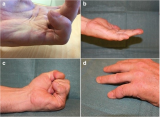 A new finger-preserving procedure as an alternative to amputation in recurrent severe Dupuytren contracture of the small finger | BMC Musculoskeletal Disorders