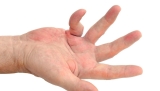 Breakthrough In Treatment For Dupuytren’s Disease As Clinical Trial Shows Efficacy Of anti-TNF Drug