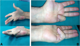 Challenges and innovations in the surgical treatment of advanced Dupuytren disease by percutaneous needle fasciotomy: indications, limitations, and medico-legal implications | Journal of Orthopaedic Surgery and Research
