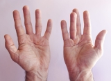 Decoding Dupuytren’s: A Climber’s Hand Disorder