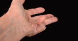 Dupuytren's Contracture: 10 Things Doctors Want You to Know – Healthgrades