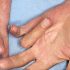 Endo takes a hands-on approach to new Dupuytren’s contracture ad