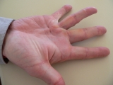 Dupuytren’s Contracture — Pain News Network