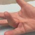 5 Hand Exercises to Try for Dupuytren’s Contracture