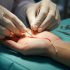 Surgery for Dupuytren’s: 5 Facts What You Need to Know About Advanced Treatment Options