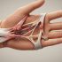 Dupuytren’s Recurrence: Why It Happens and How to Prevent It
