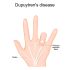 Public Awareness of Dupuytren’s Contracture in Saudi Arabia