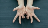 Treating Dupuytren contracture without surgery