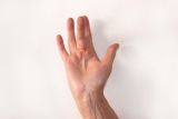 What is Dupuytren’s contracture and how serious is it?